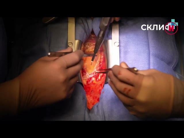 Операция по шунтированию артерий пациенту с атеросклерозом