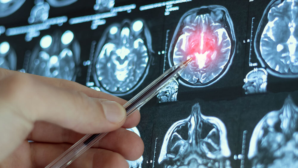 В лобной коре уловили сигнал запуска навязчивого поведения