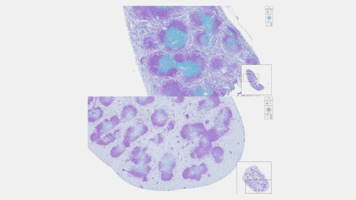 Раковые клетки