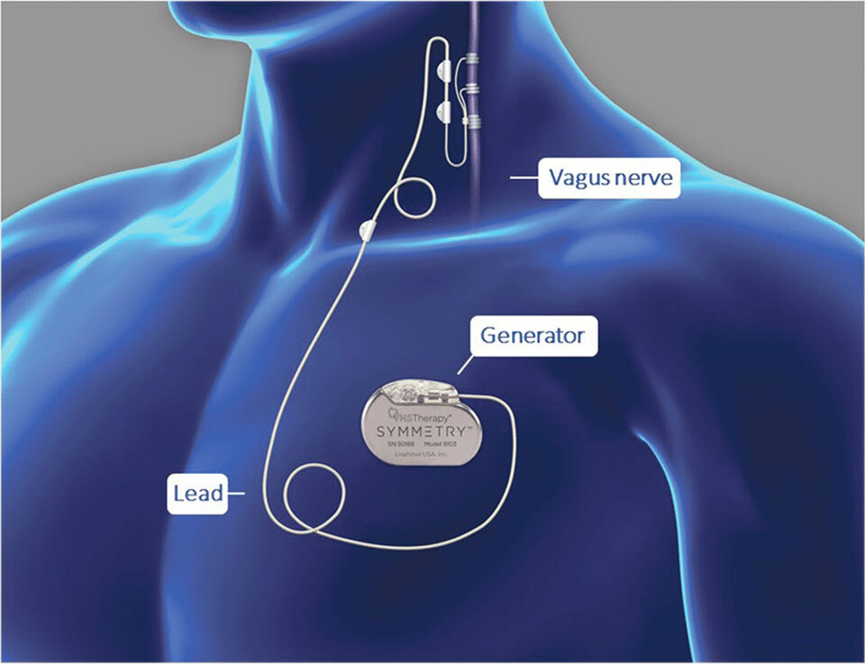 Имплантат для лечения депрессии