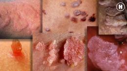 Вакцина от ВПЧ — лучшее украшение для девушек и мужчин