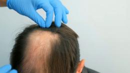 Новый метод против облысения у мужчин